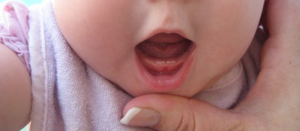 Види і симптоми стоматиту у немовляти