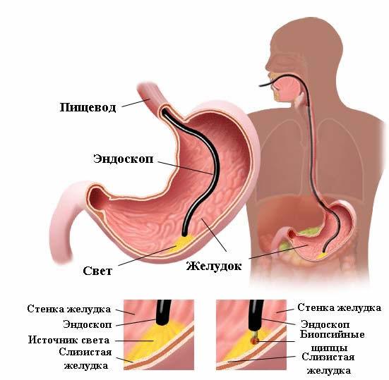 Виразка шлунка симптоми і лікування хвороби