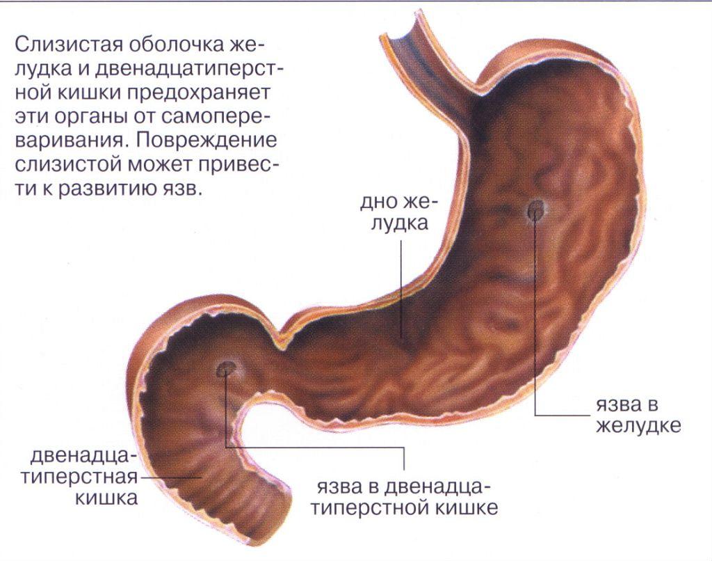 Виразка шлунка симптоми і лікування хвороби