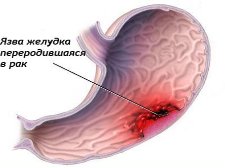 Виразка шлунка симптоми і лікування хвороби