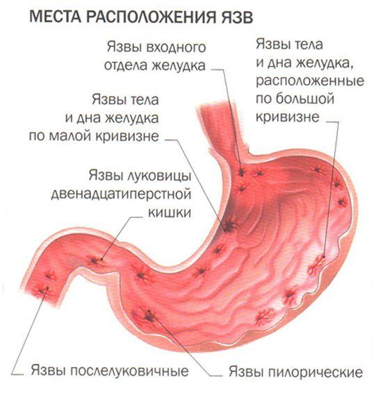 Виразка шлунка симптоми і лікування хвороби