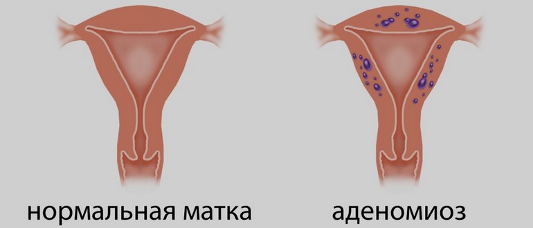 Визанна лікування аденоміозу — Жіноче здоров’я