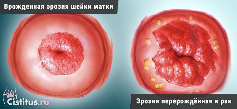 Вроджена ерозія шийки матки у жінок