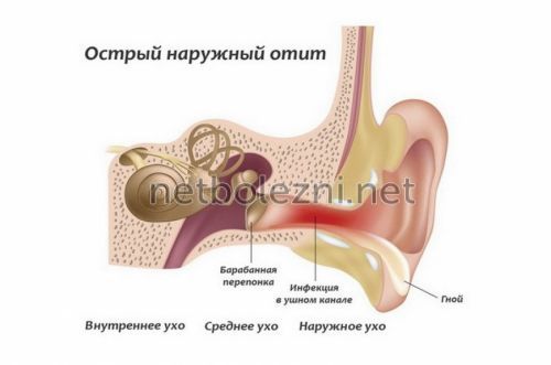 Вушні краплі при болю у вусі: які вибрати при застуді, хороші, але недорогі