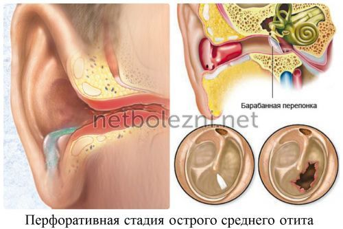 Вушні краплі при болю у вусі: які вибрати при застуді, хороші, але недорогі