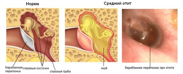 Які антибіотики краще приймати при отиті у дорослих і дітей. Як застосовують антибіотики при отиті у дорослих?