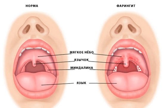 Які бувають лор-захворювання горла та гортані гострі і хронічні прояви терапія