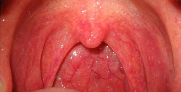 Які бувають лор-захворювання горла та гортані гострі і хронічні прояви терапія