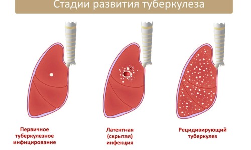 Які бувають види туберкульозу