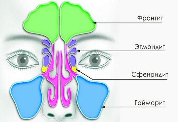 Як і чим лікувати фронтит у дорослих