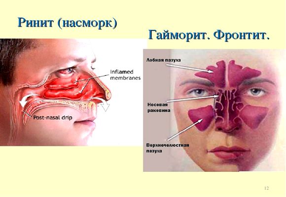 Як і чим лікувати фронтит у дорослих
