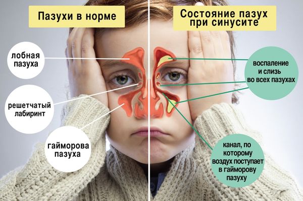 Як і чим лікувати гайморит в домашніх умовах