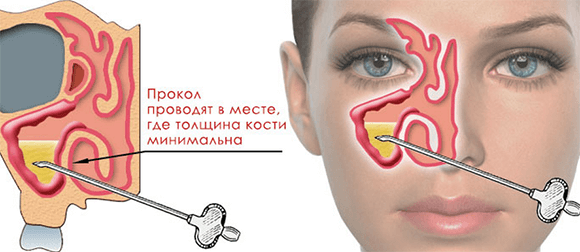 Як і чим лікувати грибок в носі