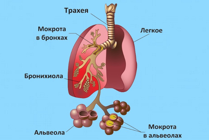 Як і чим лікувати трахейный кашель 2019