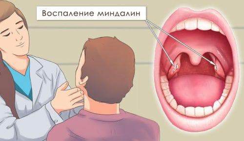 Як і чим лікувати запалення і біль у носоглотці в домашніх умовах швидко