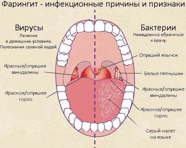 Як і чим правильно лікувати фарингіт при вагітності