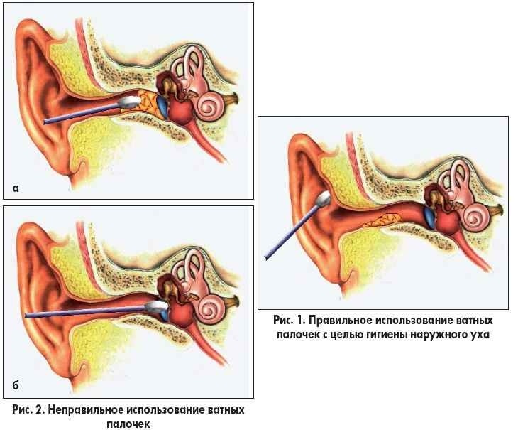 Як чистити вуха перекисом водню в домашніх умовах