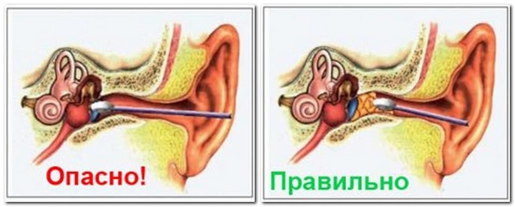 Як чистити вуха перекисом водню в домашніх умовах