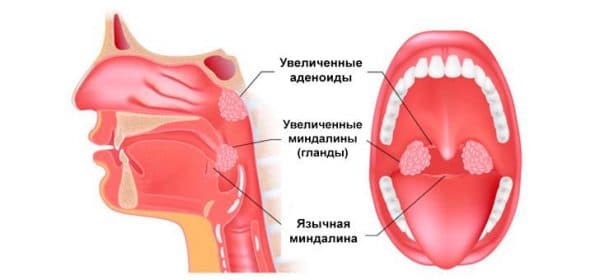 Як лікувати аденоїди у дитини в домашніх умовах народними засобами без операції