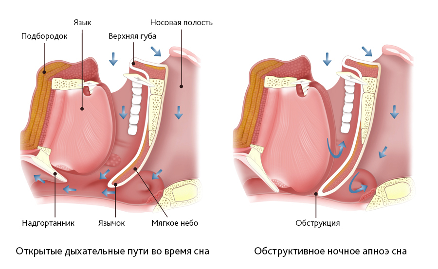 Як лікувати апное сну