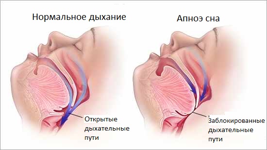 Як лікувати апное сну