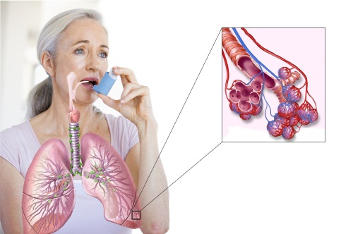 Як лікувати бронхіальну астму у дорослих в домашніх умовах