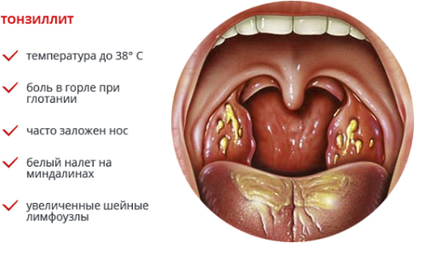 Як лікувати декомпенсований тонзиліт