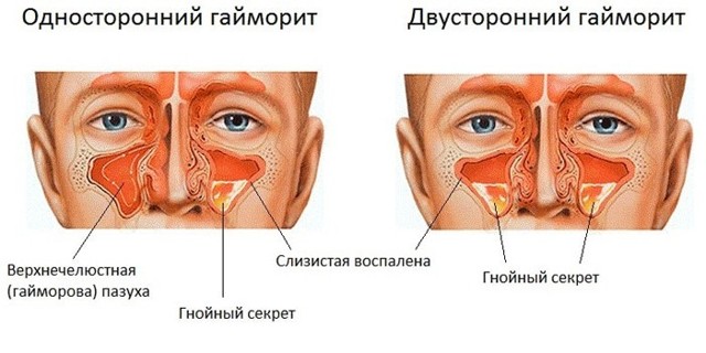 Як лікувати двосторонній гайморит у дитини і дорослого