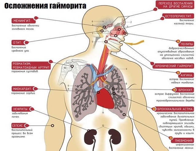 Як лікувати двосторонній гайморит у дитини і дорослого