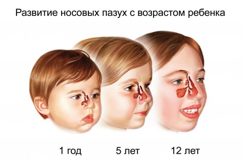 Як лікувати двосторонній гайморит у дитини і дорослого