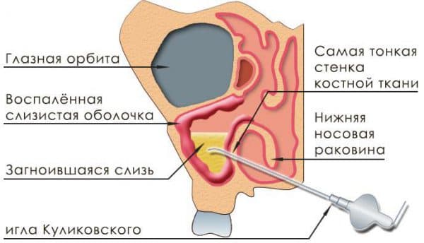 Як лікувати гайморит в домашніх умовах чим швидко вилікувати