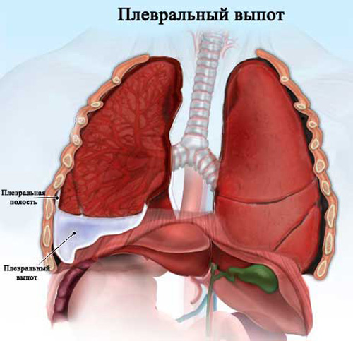 Як лікувати гнійний плеврит
