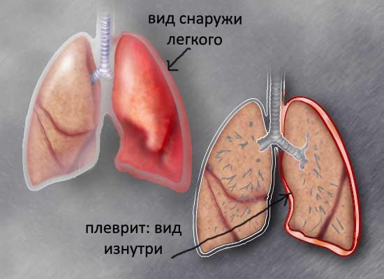Як лікувати гнійний плеврит Як лікувати гнійний плеврит