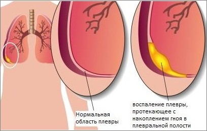 Як лікувати гнійний плеврит Як лікувати гнійний плеврит