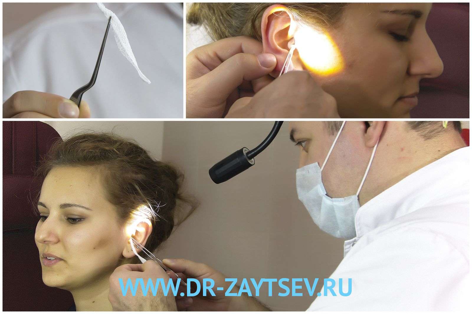 Як лікувати гострий середній отит вуха