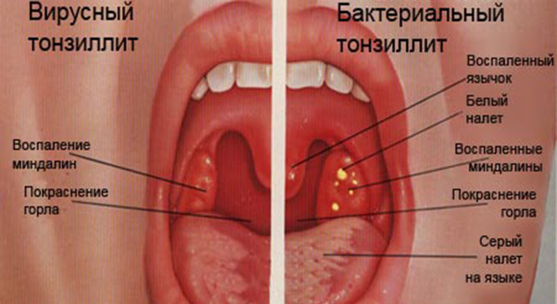 Як лікувати гострий тонзиліт