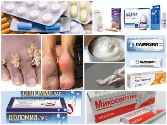 Як лікувати грибок стопи в домашніх умовах
