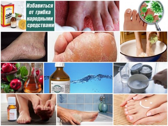 Як лікувати грибок стопи в домашніх умовах