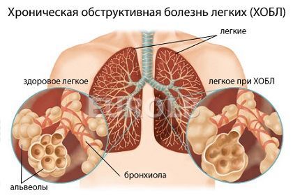 Як лікувати ХОЗЛ у дорослих назавжди: Чи можна вилікувати ХОЗЛ