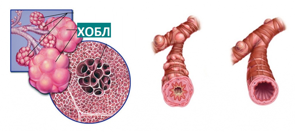 Як лікувати ХОЗЛ у дорослих назавжди: Чи можна вилікувати ХОЗЛ