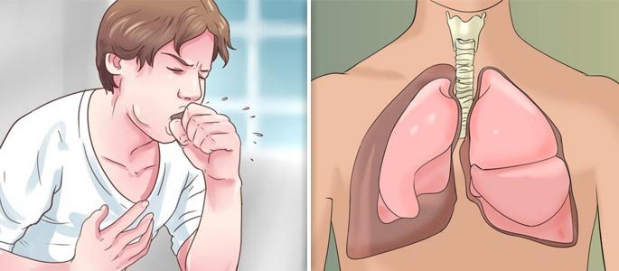 Як лікувати кашель при гаймориті