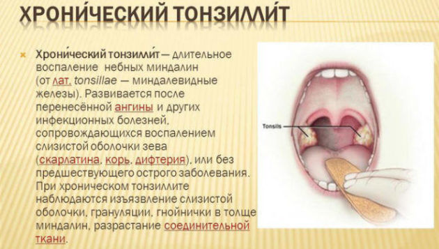 Як лікувати кашель при тонзиліті