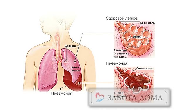 Як лікувати кашель у лежачих хворих