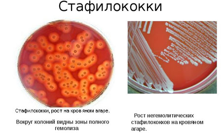 Як лікувати кашель верхніх дихальних шляхів. Лікування інфекцій верхніх дихальних шляхів у дітей