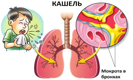 Як лікувати кашель верхніх дихальних шляхів. Лікування інфекцій верхніх дихальних шляхів у дітей