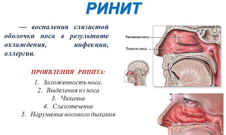Як лікувати кашель верхніх дихальних шляхів. Лікування інфекцій верхніх дихальних шляхів у дітей