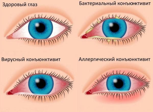 Як лікувати кон’юнктивіт у домашніх умовах