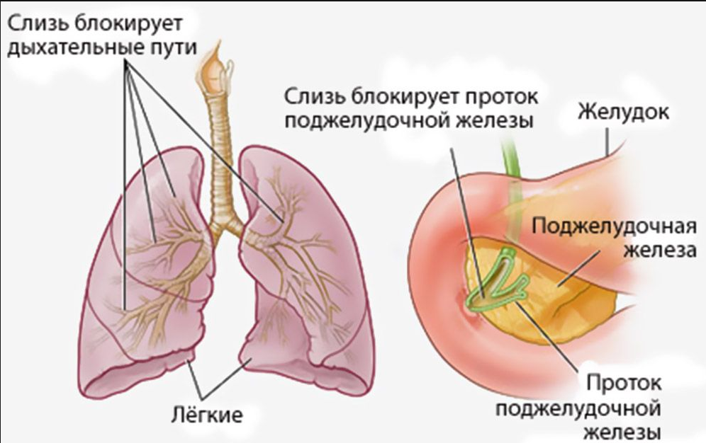 Як лікувати муковісцидоз у дітей