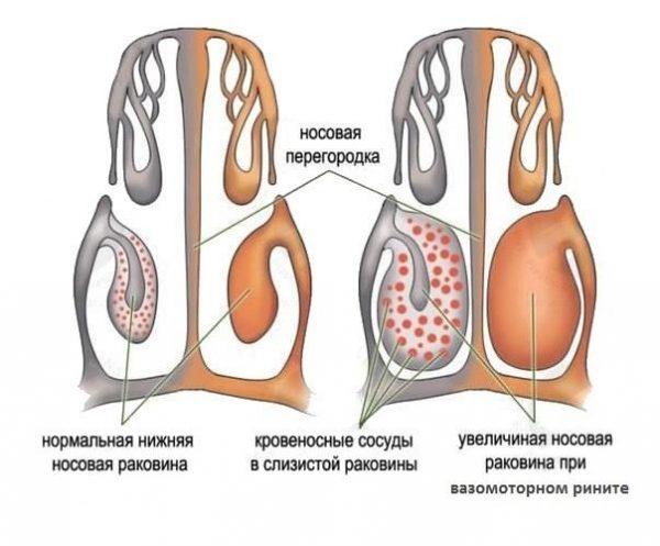 Як лікувати нежить у домашніх умовах