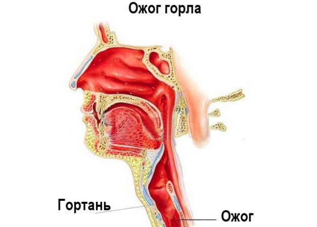 Як лікувати опік слизової горла Як лікувати опік слизової горла